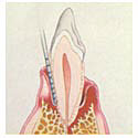 advanced_periodontitis_tooth.jpg (4427 bytes)