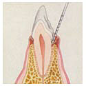 gingivitis_tooth.jpg (4411 bytes)