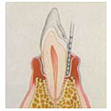 moderate_periodontitis_tooth.jpg (4314 bytes)